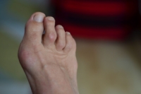 Causes and Treatment of Hammertoe